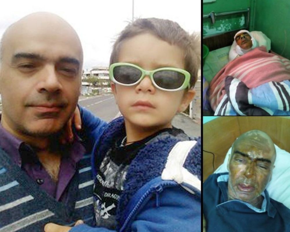 Vater Giovanni - vor und nach dem S&auml;ureanschlag